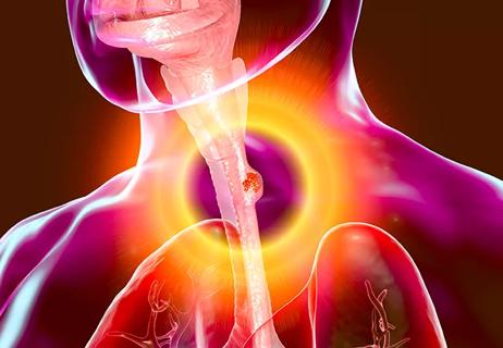 Esophageal cancer, illustration