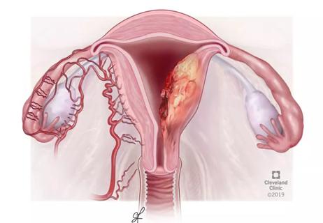 Illustration of endometrial cancer