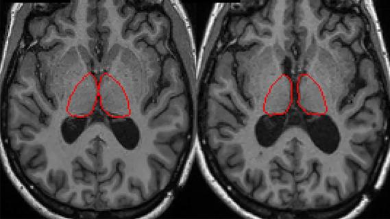 two brain MRIs side by side with red circles on them