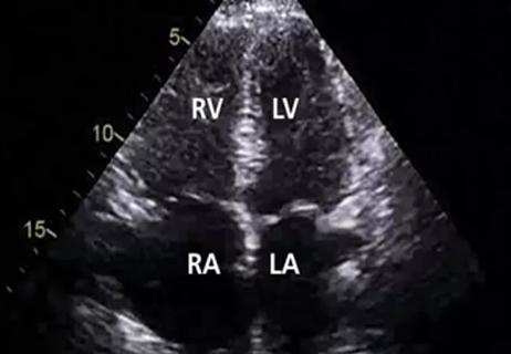 pulmonary hypertension