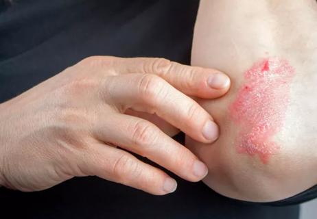 19-RHE-1011-psoriasis-650&#215;450