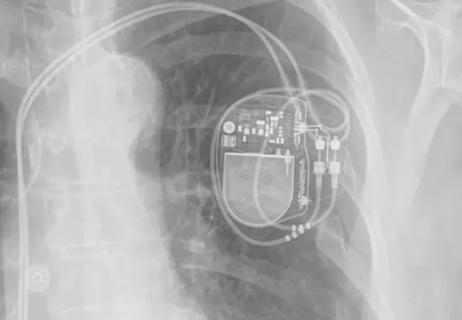 X-ray showing a dual-chamber pacemaker
