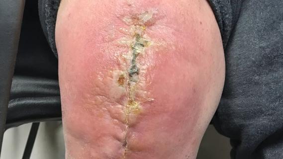 Infection after knee arthroplasty