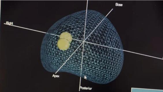 Image of AI prostate cancer research