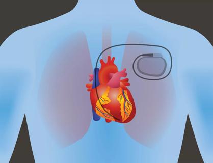 Pacemaker