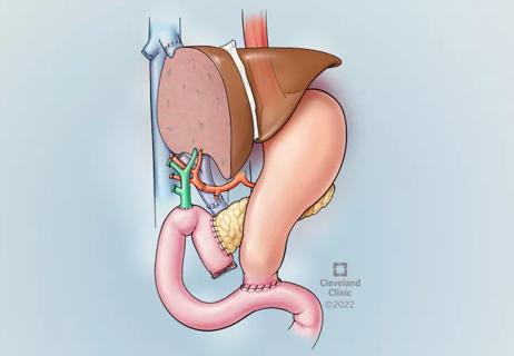 whipple procedure animation