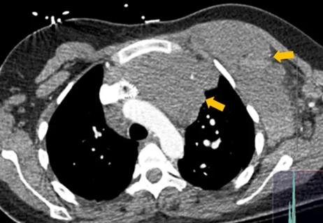 Case Study: CTEPH and Mediastinal Venous Malformation