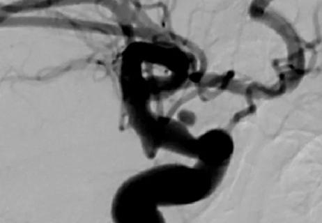 intracranial aneurysm