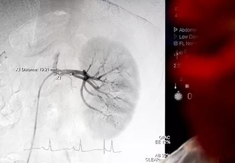 New Targets for Radiation Therapy Include Cardiac AF Ablations and Renal  Denervation