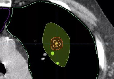 SBRT targeted radiation