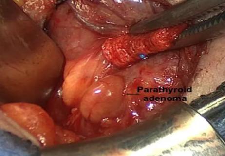 parathyroid adenoma