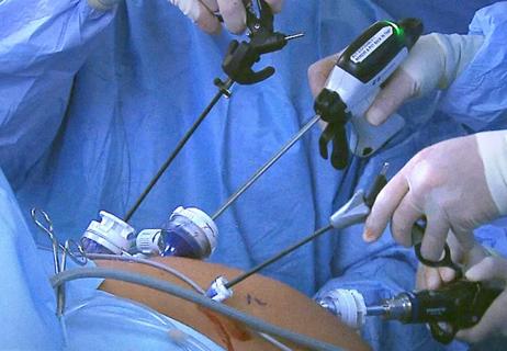 Using laparoscopic instruments: Ultrasonic energy device and flexible 3-D scopes.