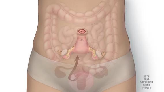 medical illustration of the repositioning of the uterus and cervix during transposition surgery