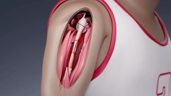 Illustration of osteosarcoma shoulder procedure