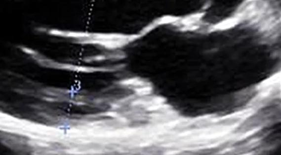 Septal Wall Subtleties in a Young Athlete