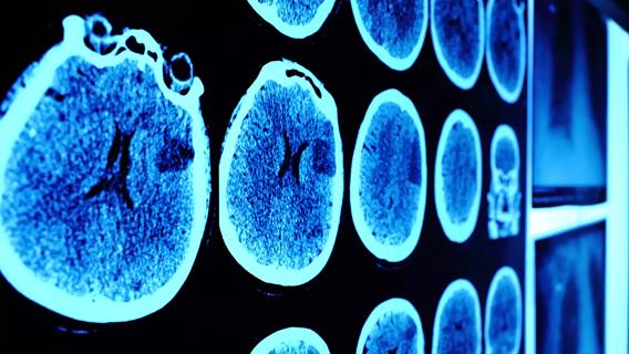 Glioblastoma
