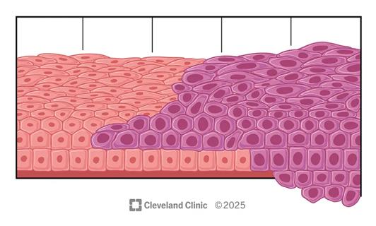 medical illustration of cervical dysplasia