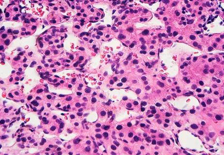 hepatocellular-carcinoma
