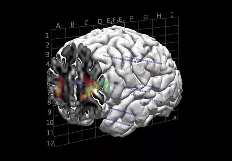 brain mapping in epilepsy