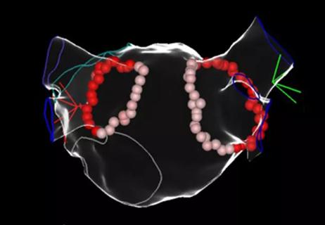 atrial fibrillation ablation