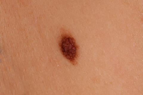 Can Melanoma Cancer Come Back?