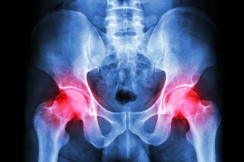Hip x-ray