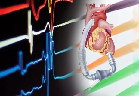 19-HRT-236-LVAD-Afib-CQD