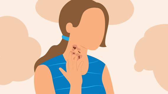 Person touching skin condition on their throat