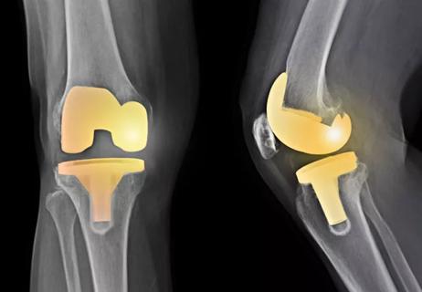 Total knee arthroplasty