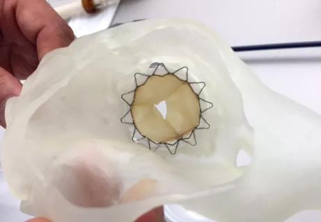 3D-printed replica of a tricuspid valve with an implanted valved stent
