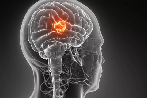 Photo of X-ray of brain with tumor