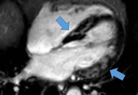 Cardiac-MRI-w-Arrows-650x450pxl