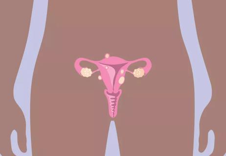 Graphic of uternie fibroid tumers placed anotomically in a silhouette of a body
