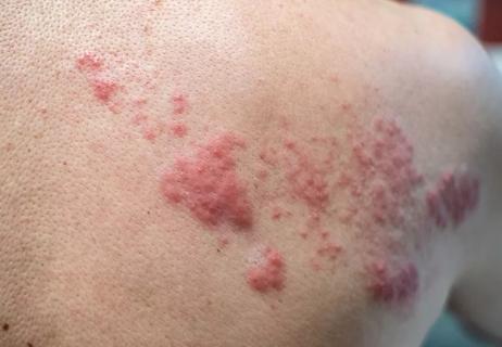 Shingles present on a shoulder of a light skinned person.