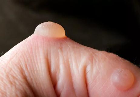 a closeup of a blister on a person's finger, on a black background.