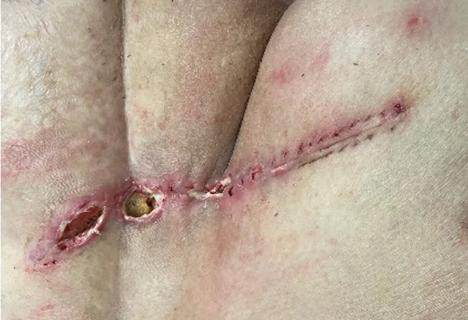 Incision after surgery to remove sarcoma