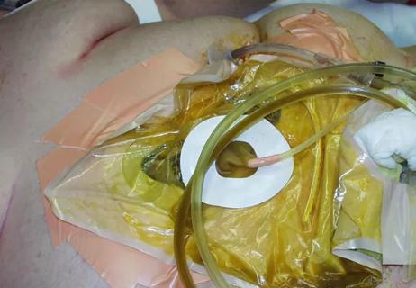 Transplant surgery