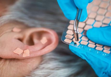 ear beads acupuncture for smoking