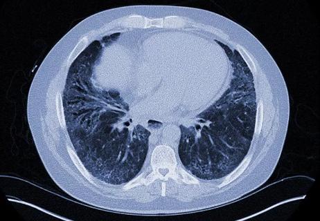 650&#215;450-Scleroderma-NSIP