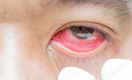 Gloved fingers pulling down lower eye lid of red, inflamed eye