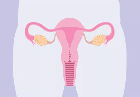 PCOS and weight