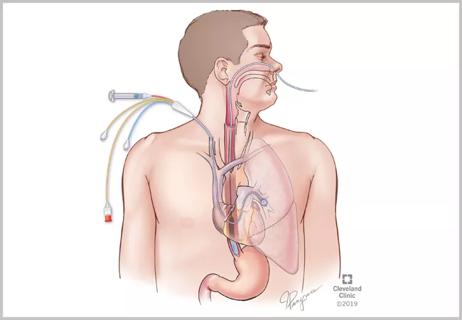 esophageal balloon