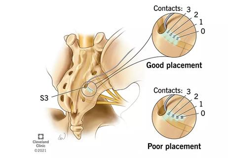 sacral neuromodulation lead