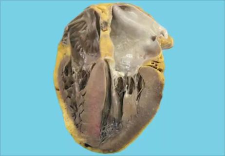 18-HRT-5612 cardiac-amyloidosis-650&#215;450