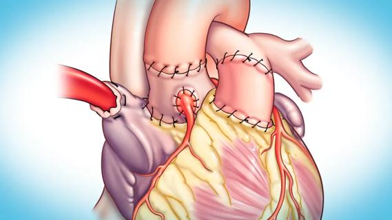heart with a grafted vein to the aorta