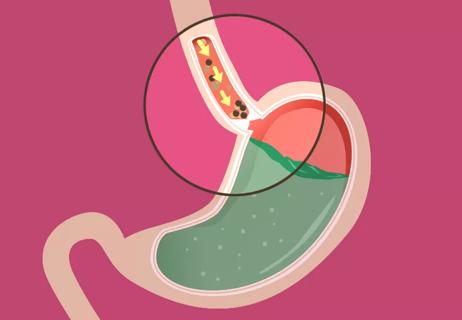 Illustration of food stuck before emptying from esophagus - achalasia