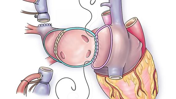 illustration of a heart operation