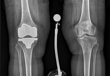 X-ray image of total knee replacement