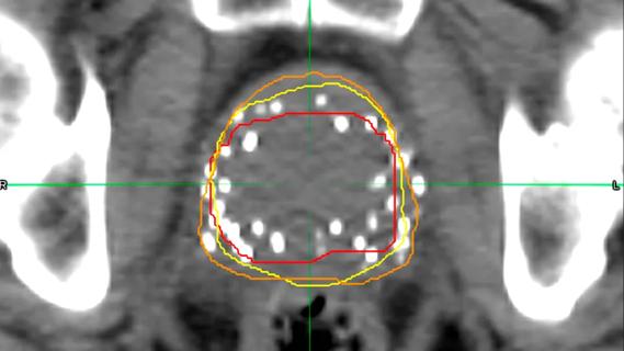 CT scan after prostate brachytherapy