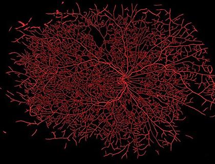 retinopathy glp 1 GLP-1 Receptor Agonists Didn't Worsen Diabetic Retinopathy